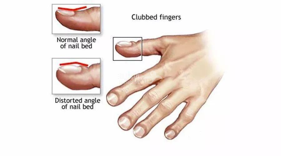 (点击图片,加入移民交流群)其实不止是杵状指,我们指甲上的很多小