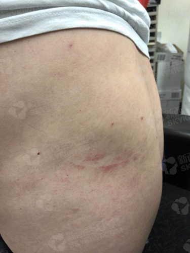 Daniel被撞得满是乌青的后背 ..