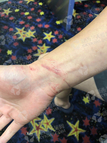 Daniel手上的擦伤痕迹 ..